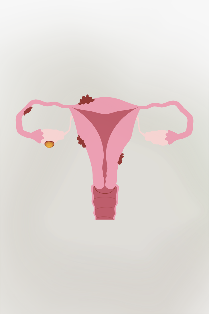 pjur_IG_KW10_Story_Endometriose-Awareness-Month (730 x 1094 px)